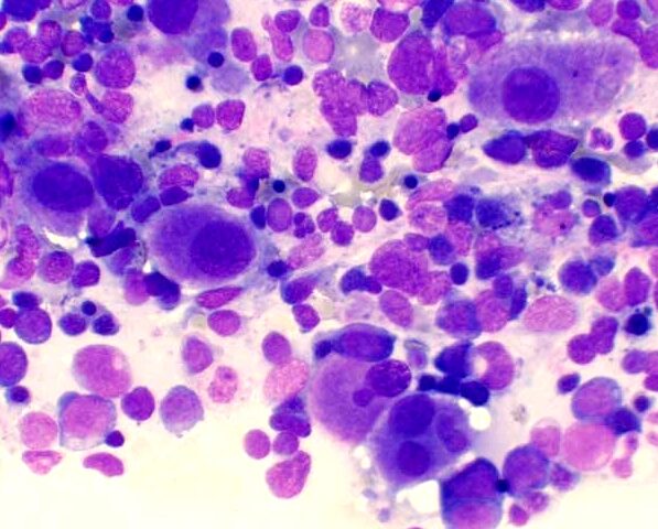 Síndromes mieloproliferativos crónicos