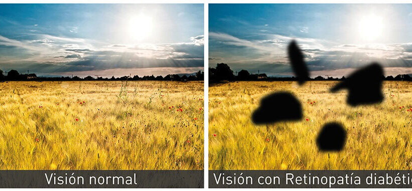 Retinopatía diabética