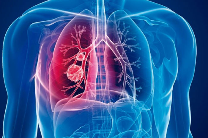 Hallan una cura mejorada para la tuberculosis más resistente y mortal