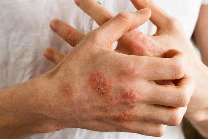 ¿Cómo reconocer la dermatitis atópica?