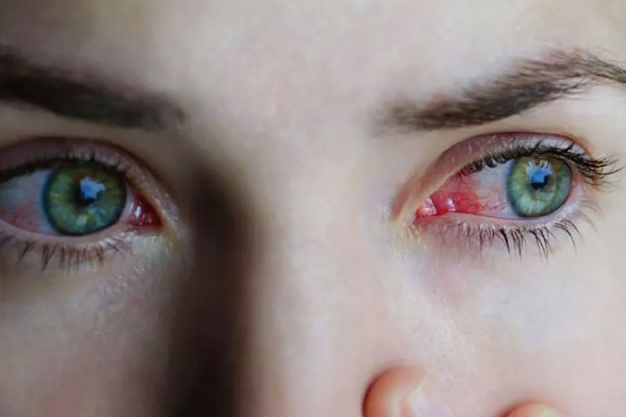 Alergia ocular: claves para erradicarla de una vez