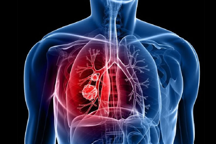 Cáncer de pulmón: se aprobó una nueva droga que abre una esperanza