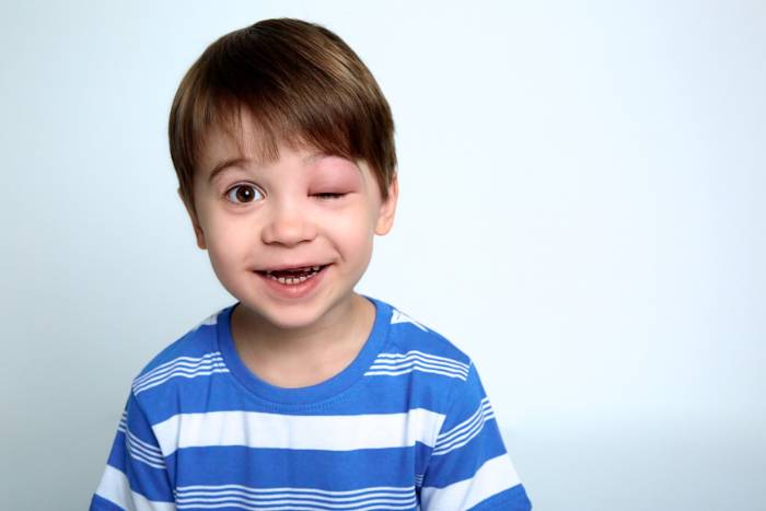 Hinchazones o edemas: ¿a qué se deben?