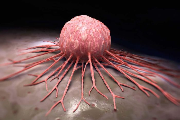 ¿Qué es el mieloma múltiple?